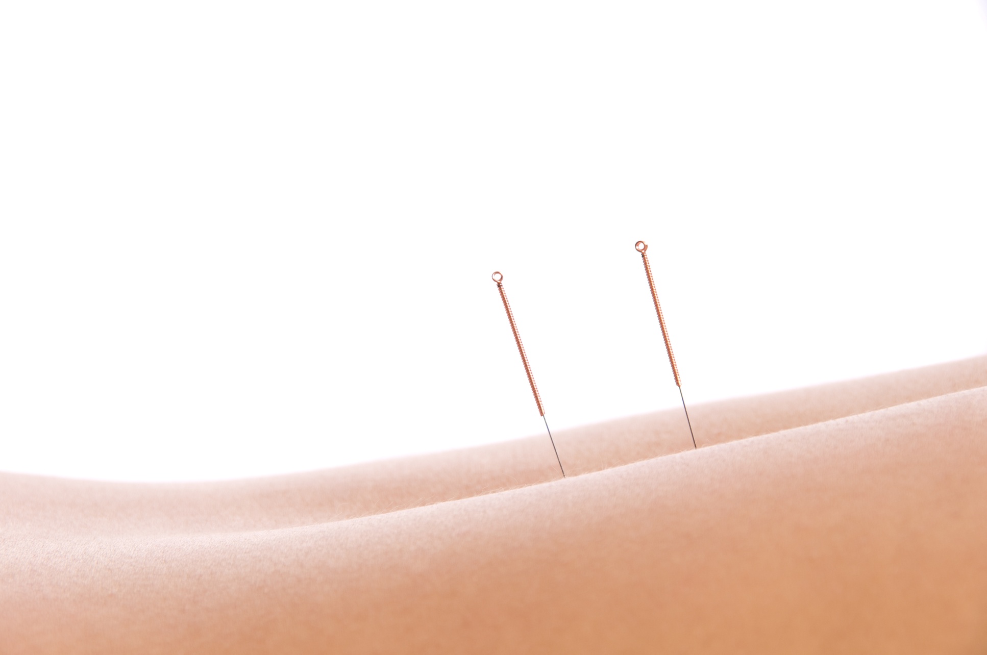 Up to 55% Off on Acupuncture at anjel Wellness