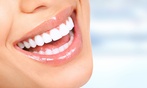 Up to 60% Off on Teeth Whitening - In-Office - Branded (Zoom, Brite Smile) at Stanton Dental Excellence