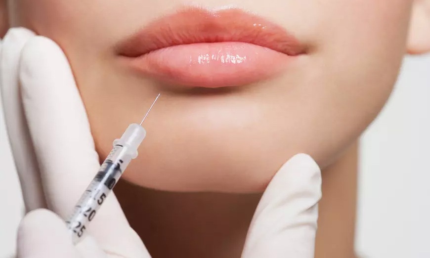 One Syringe of Revanesse Dermal Filler at BodyBrite Mississauga