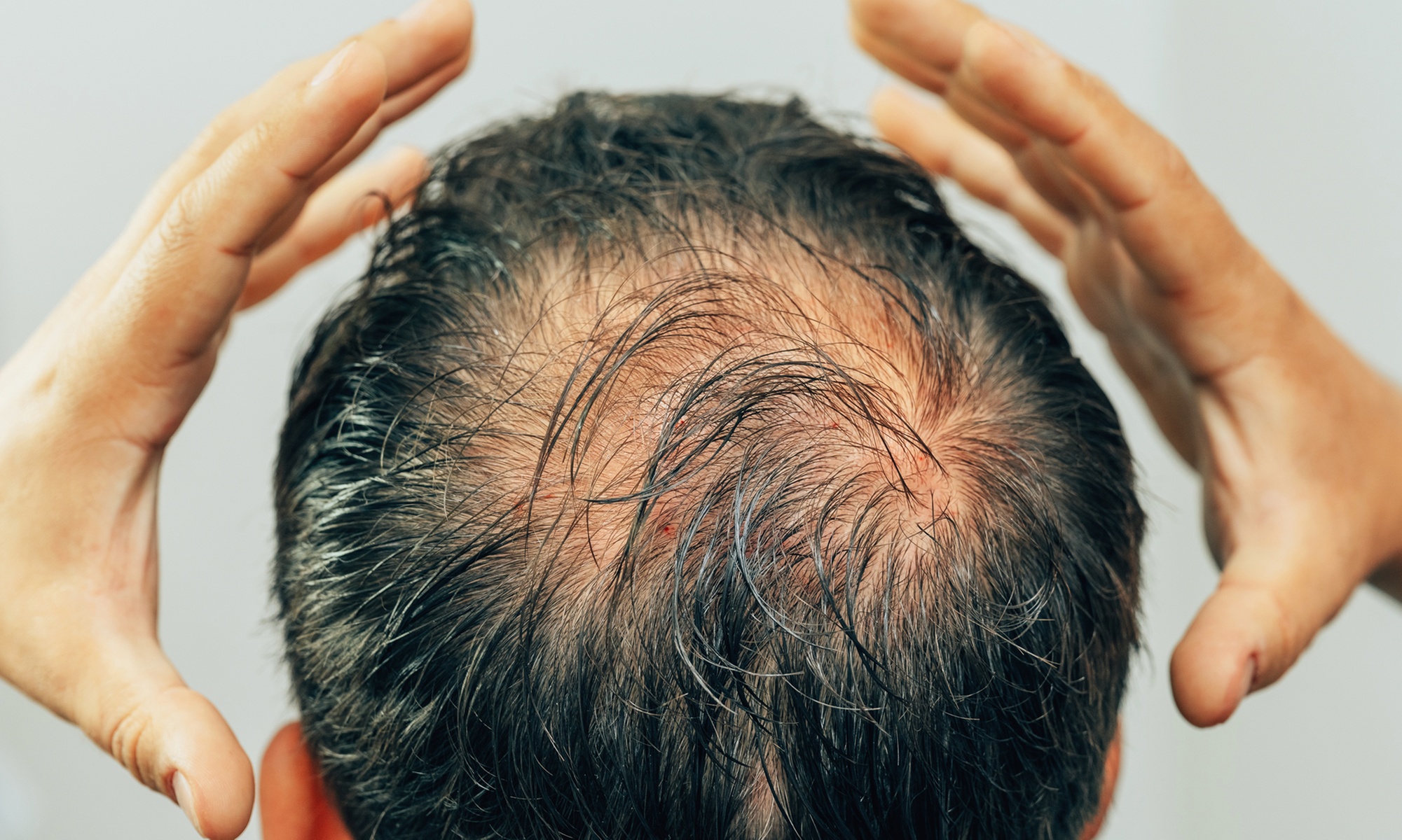 Mesotherapie für den Kopf bei Vita Day Spa Naturheilpraxis