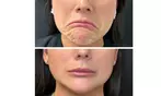 Youthful Confidence Awaits with 20, 40, or 60 Units of Botox Treatment