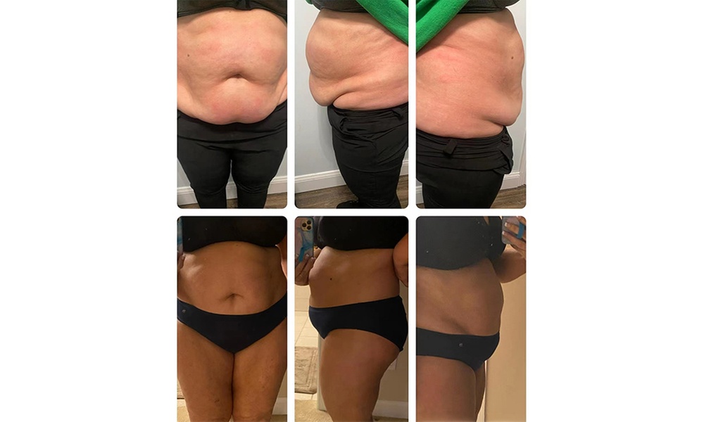 Radio Frequency Skin Tightening for Thighs or/and Abdomen and More