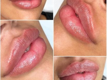 Add Volume with Juvederm Filler Treatment Beverlys Med Spa