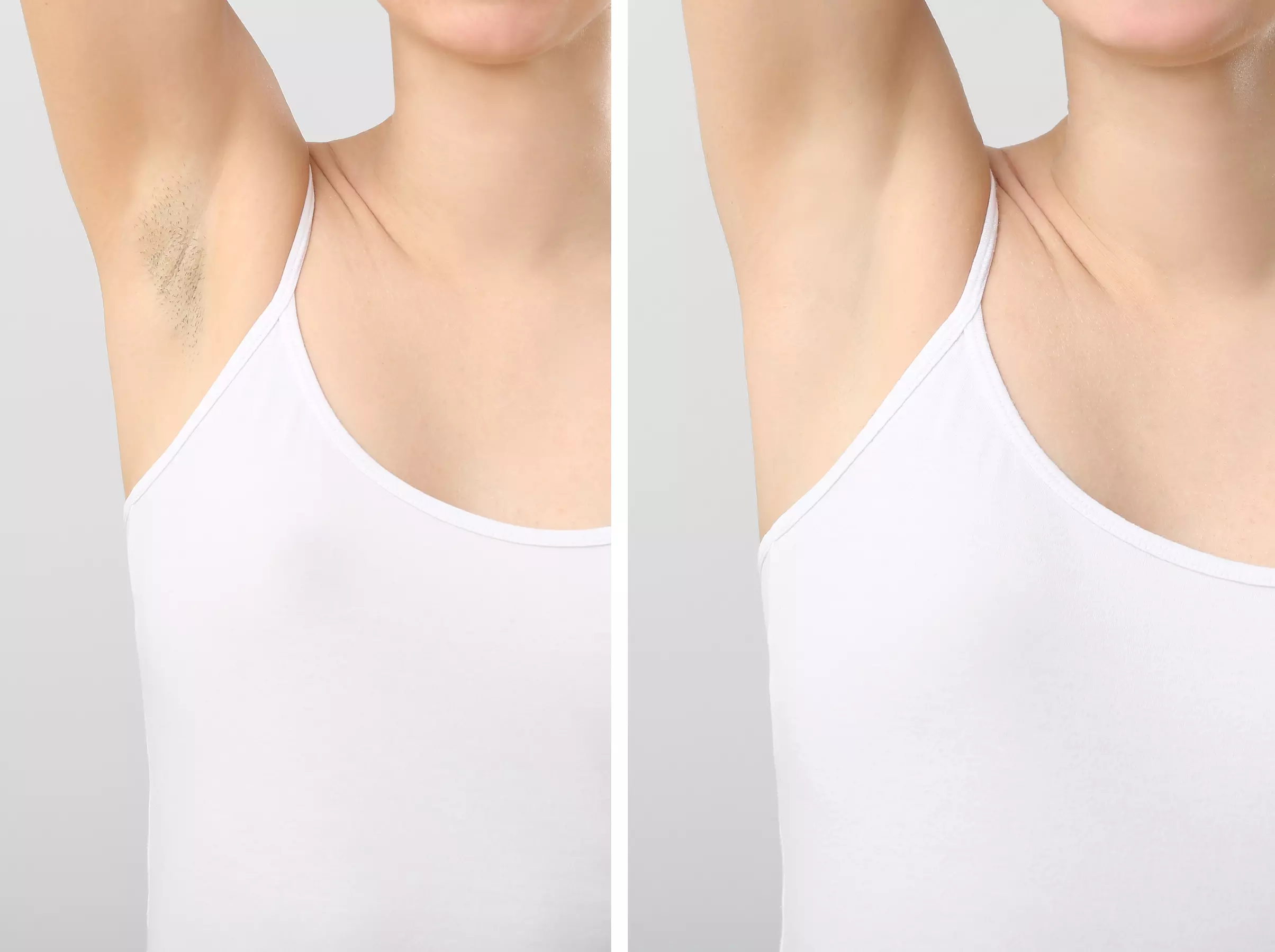 Laser Hair Removal (Summer Special for Women or Men): Choose Your Area