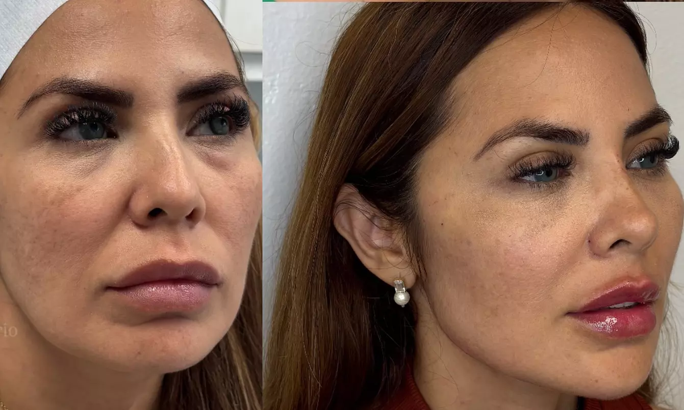 Achieve Plump Lips with One or Two Syringes of Revanesse Lips (1.2mL)