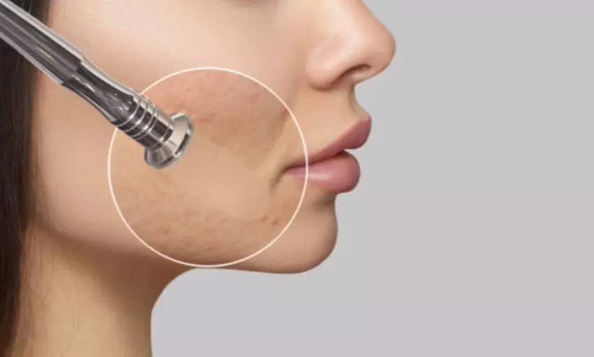 Higiene facial con opción a microdermoabrasión y radiofrecuencia