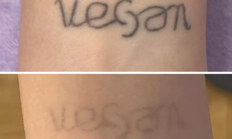 1 or 3 Sessions of Laser Tattoo Removal for XS, Small & Medium Areas