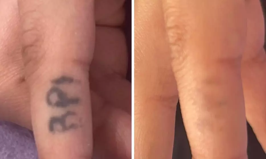 1 or 3 Sessions of Laser Tattoo Removal for XS, Small & Medium Areas