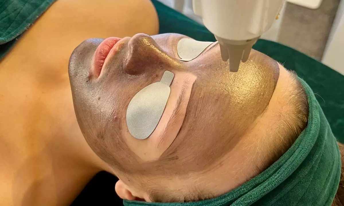 Laserowy peeling węglowy i spersonalizowana maska