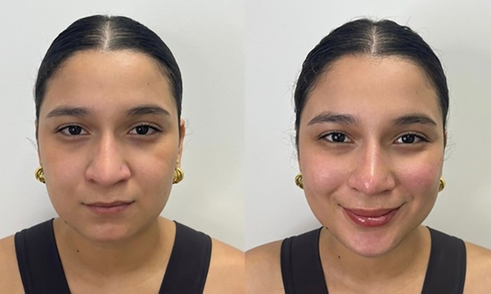 1 o 3 sesiones de mesoterapia facial inyectada