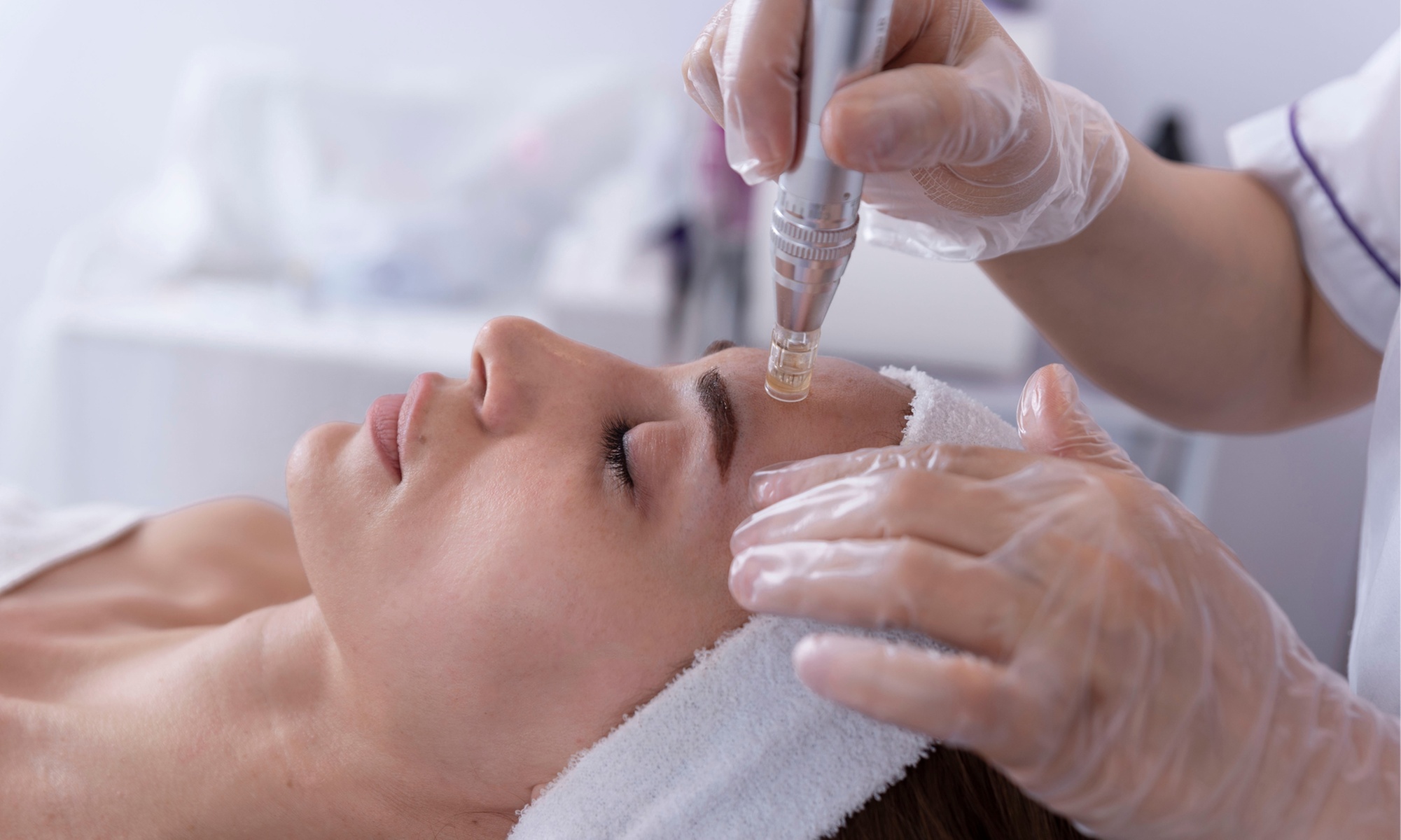 Microneedling facial con Dermapen