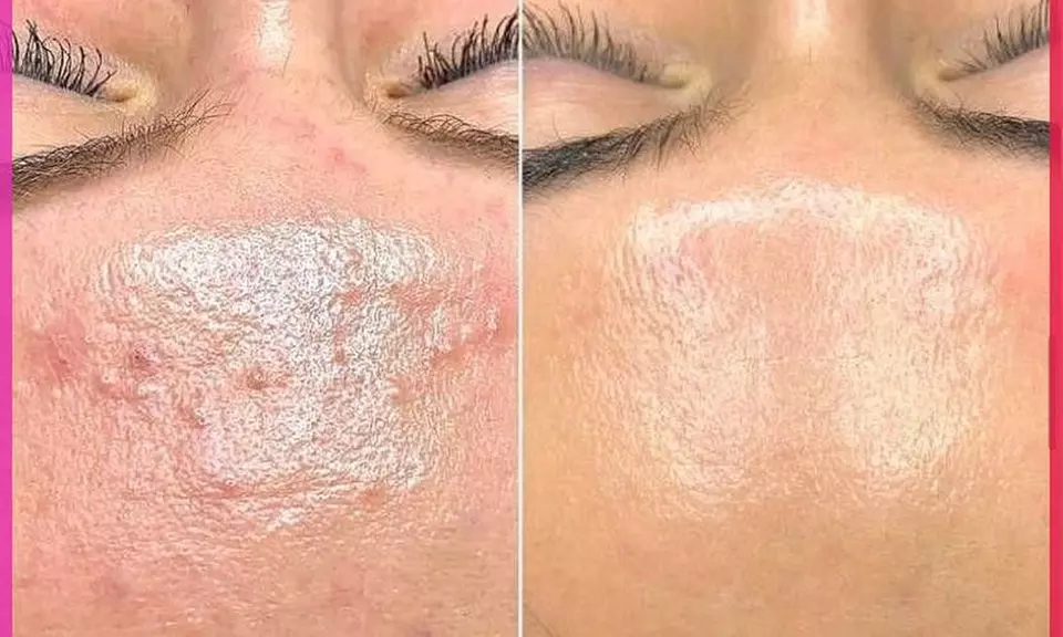 Microneedling mit Massage / Gesichtsbehandlung mit Peeling, Maske uvm.