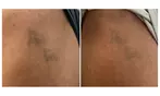 Three Tattoo Removal Sessions on an Area Up to 2x2, 3x3 or 4x4 Inches