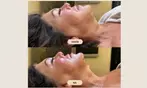 Microneedling of Korean Collagen Booster in Amsterdam