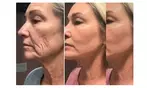 Experience 30-75 Minutes of Radio Frequency Skin Lifting Facials