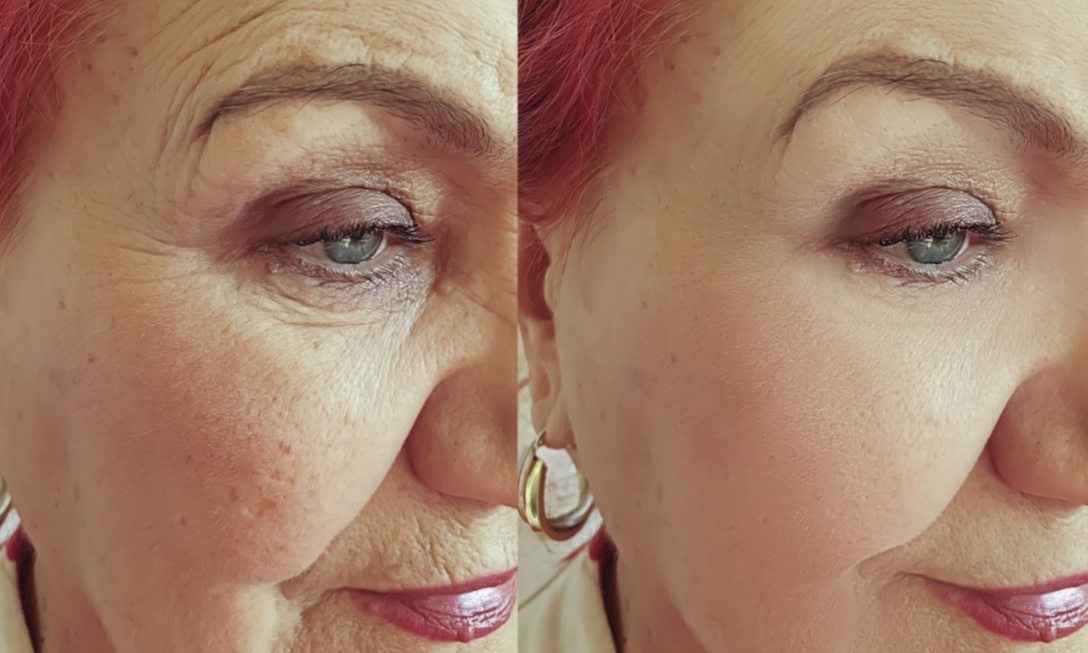 22% Off Botox + Juvederm at Studio Donna Med Spa