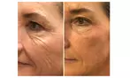 HIFU Facial Treatments: Foxy Eyes, Double Chin, Neck & Lower Face