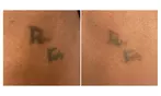Three Tattoo Removal Sessions on an Area Up to 2x2, 3x3 or 4x4 Inches