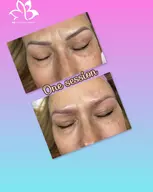 Eyebrow Tattoo Removal: Save Up to 30% Off at MB Advanced Beauty MED!