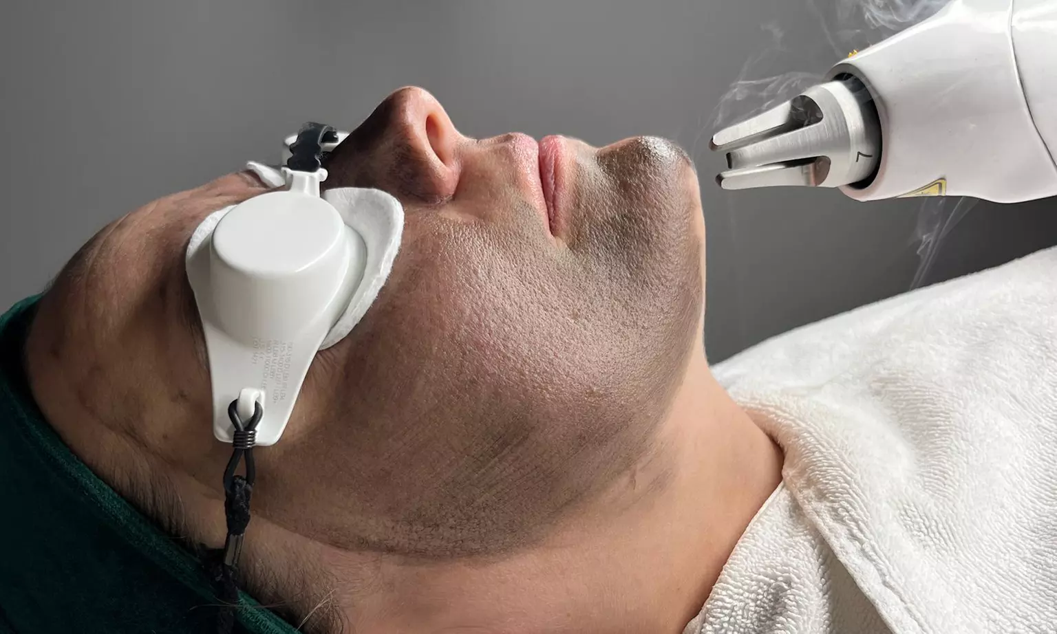 Do 80% zniżki na Zabieg na twarz - peeling w SKINTEC Laser