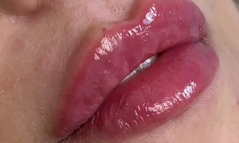 Achieve Plump Lips with One or Two Syringes of Revanesse Lips (1.2mL)