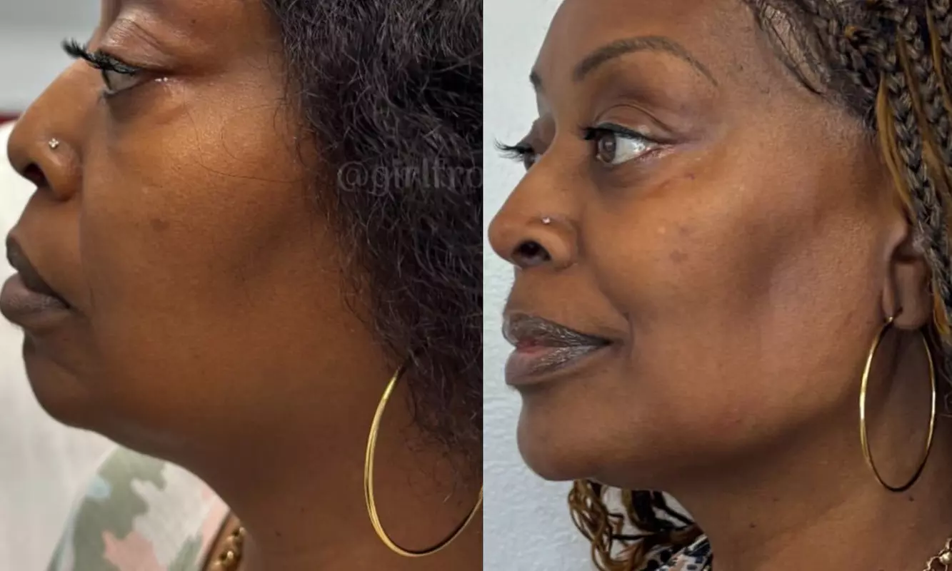 Achieve Plump Lips with One or Two Syringes of Revanesse Lips (1.2mL)