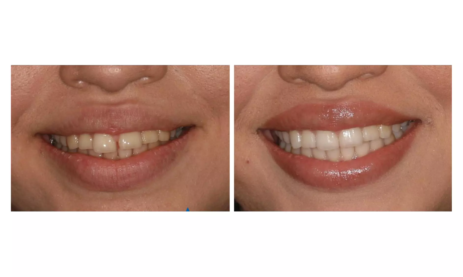 Clear Aligner Orthodontic Treatment