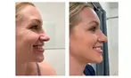 Experience 30-75 Minutes of Radio Frequency Skin Lifting Facials