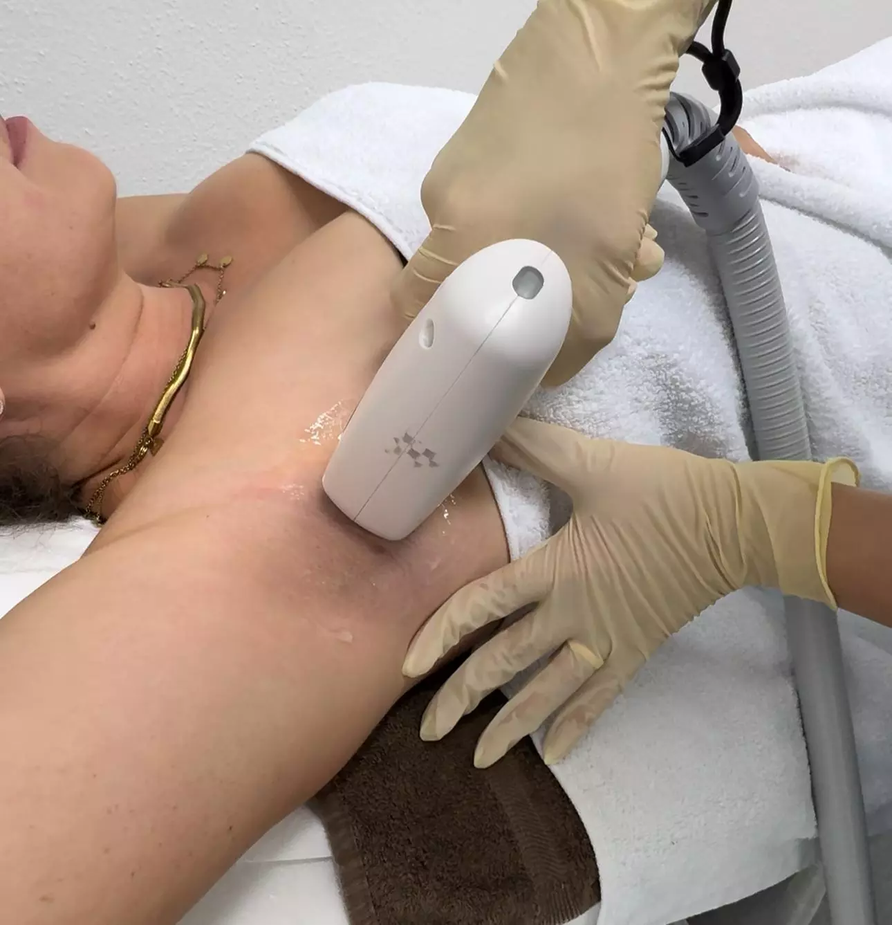 3x oder 5x Laser Haarentfernung an kleiner Zone für Frauen oder Männer