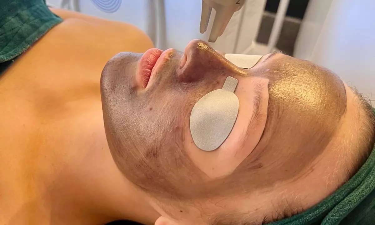 Laserowy peeling węglowy i spersonalizowana maska