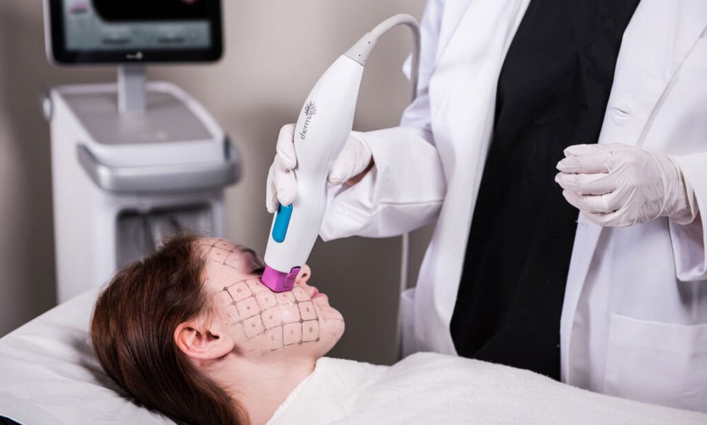 5th Gen Thermage FLX Skin Tightening & Lifting the Face, Jawline &More
