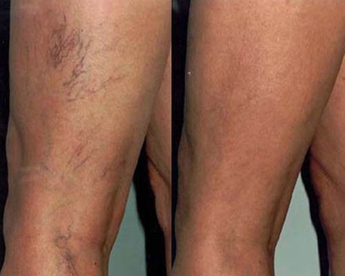 Discover Non-Invasive Spider Vein Consultation and Treatment