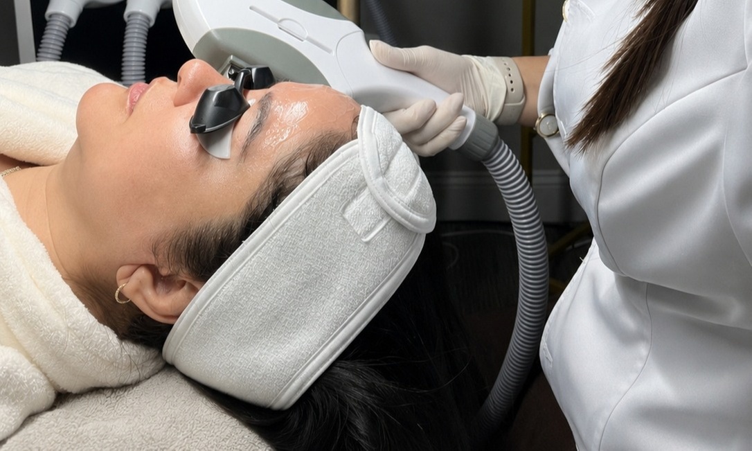 One, Two or Three IPL Photo Facials w/ Enzyme Peel/ Microdermabrasion