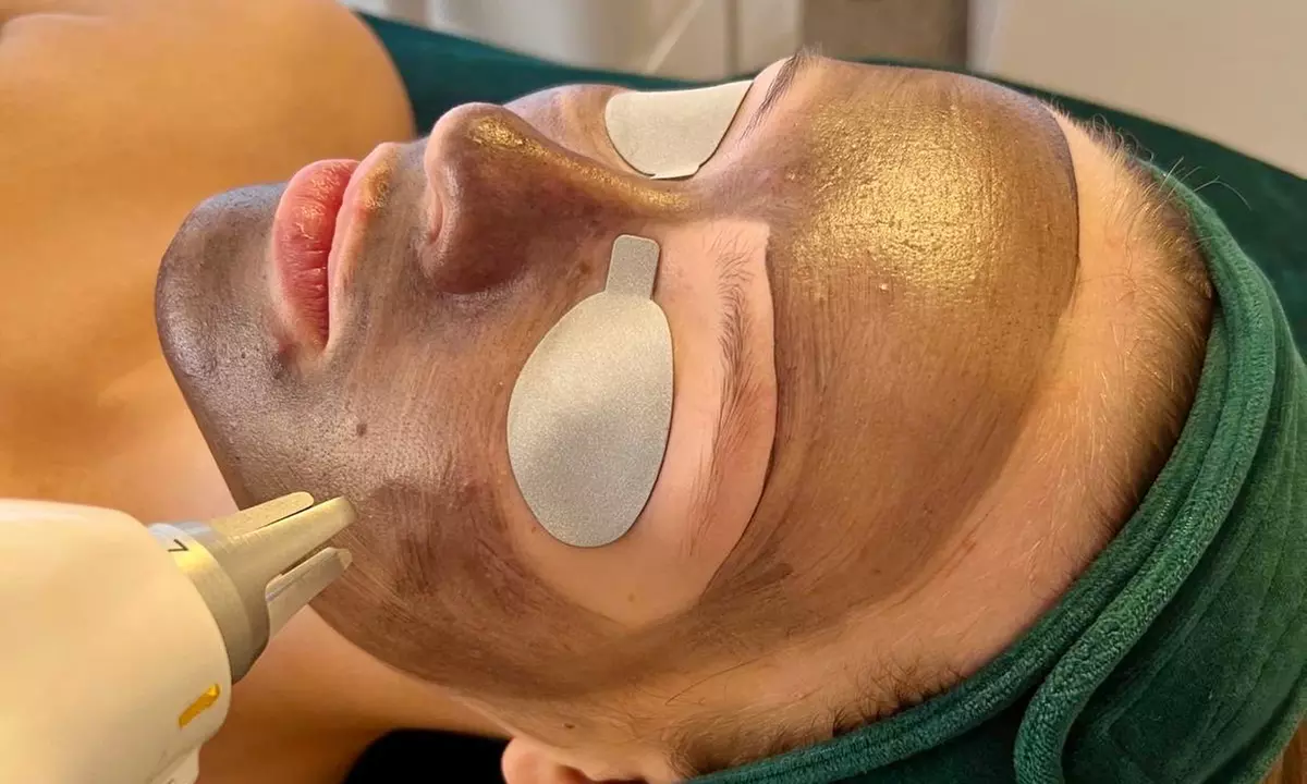 Laserowy peeling węglowy i spersonalizowana maska