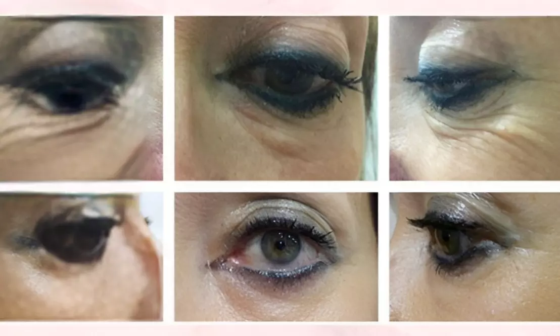 PlexR: huidverstrakking zonder snijden