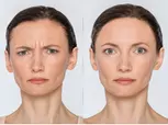 20, 40, or 60 Units of Botox for Fine Lines & Full-Face Refresh