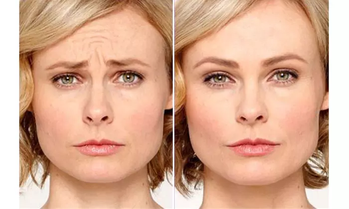 Xeomin Smartox Units and LED Skin Rejuvenation Treatments
