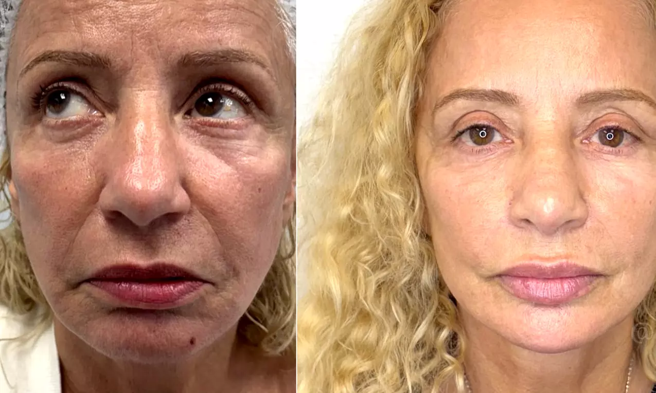 Achieve Plump Lips with One or Two Syringes of Revanesse Lips (1.2mL)