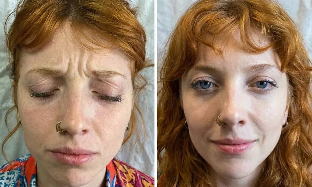 Smooth Skin Injections for 1, 2, or 3 Areas: Natural, Refreshed Look