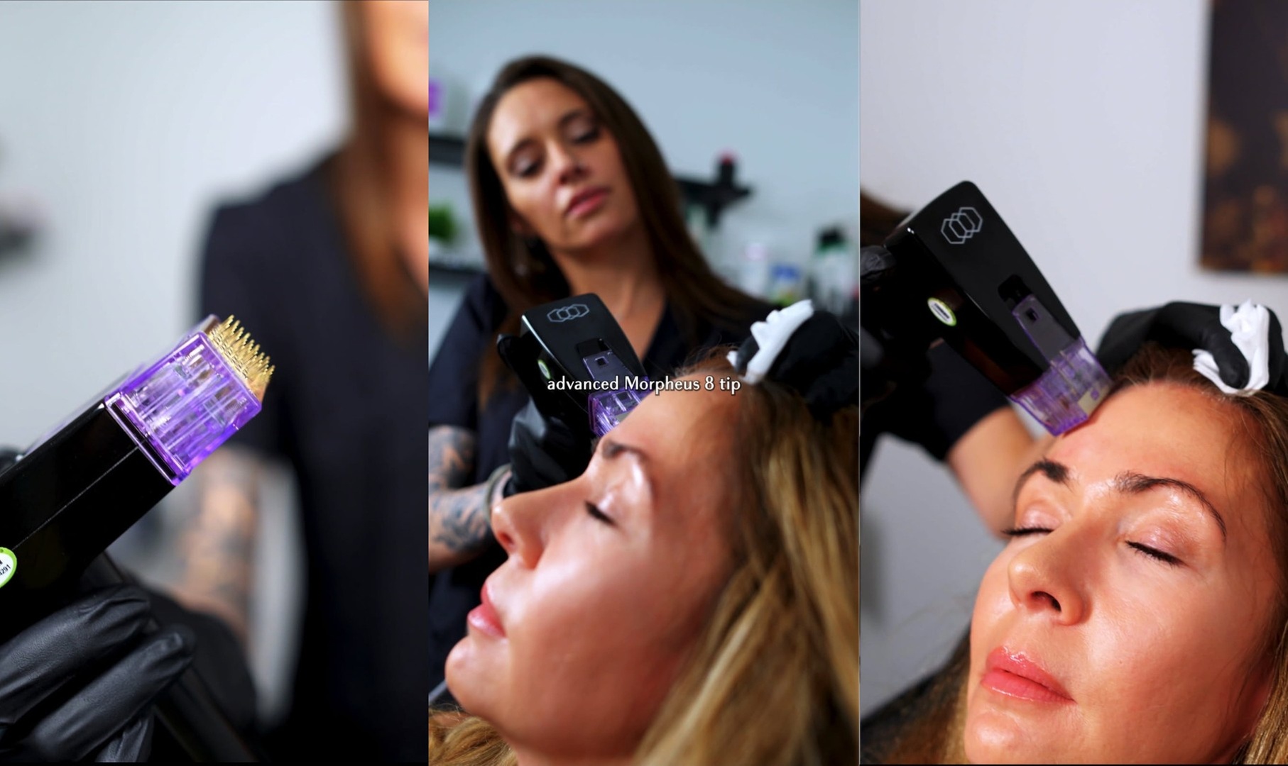 The Real Morpheus8, HIFU and PRP packages at 365 Clinical Care