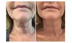 HIFU Facial Treatments: Foxy Eyes, Double Chin, Neck & Lower Face