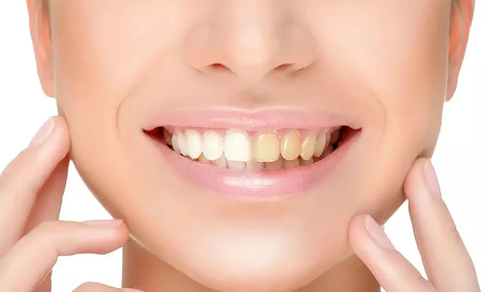 30 Min. kosmetisches Zahn-Bleaching inkl. Beratung für 1 Person