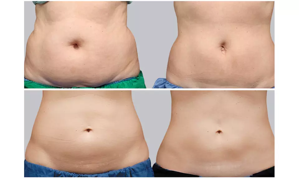 Tone with EMS: 1, 2, 3, or 10 Sessions of Muscle Sculpting