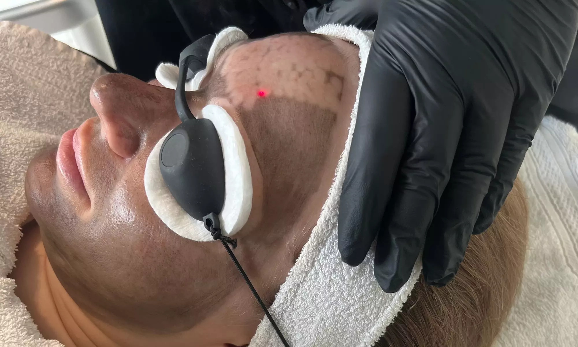 Laserowy peeling węglowy i spersonalizowana maska