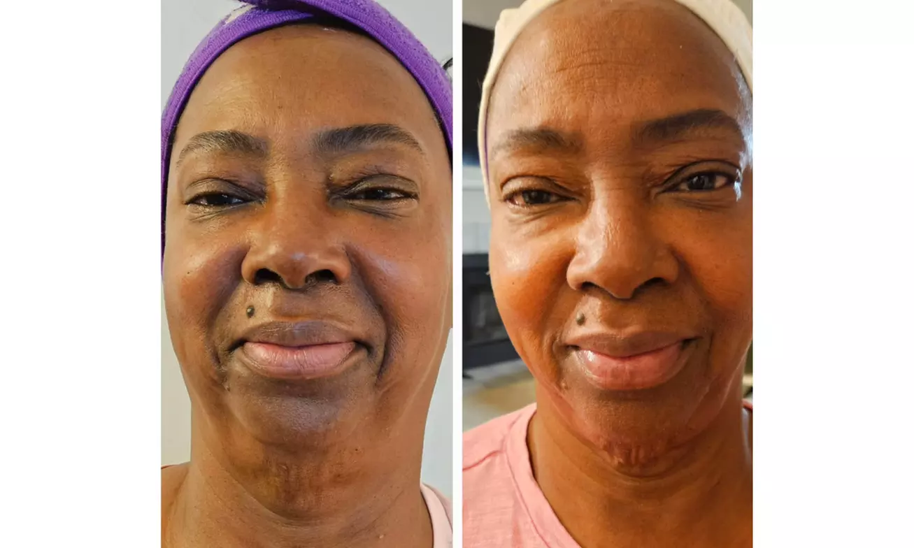 One or Two Signature Facial with Microdermabrasion or Express Facial