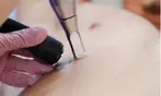 Three Tattoo Removal Sessions on an Area Up to 2x2, 3x3 or 4x4 Inches