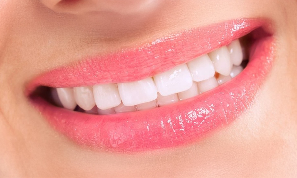 One or Two Porcelain Veneers or Cosmetic Porcelain Crown