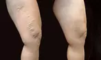Spider Vein Removal - Injection at Charming Skin Vein Center