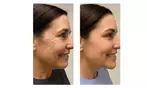 Experience 30-75 Minutes of Radio Frequency Skin Lifting Facials