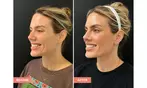 Youthful Confidence Awaits with 20, 40, or 60 Units of Botox Treatment